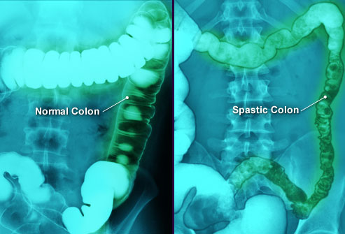 huzursuz bağırsak sendromu
